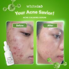 a43257e2d07b4eeba1d5ec7351da297b Whitelab Acne Calming Serum