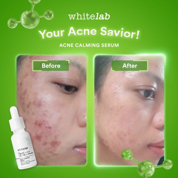 a43257e2d07b4eeba1d5ec7351da297b Whitelab Acne Calming Serum
